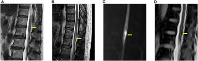Spinal Cord Infarction: A Single Center Experience and the Usefulness of Evoked Potential as an Early Diagnostic Tool
